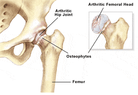 Arthritis